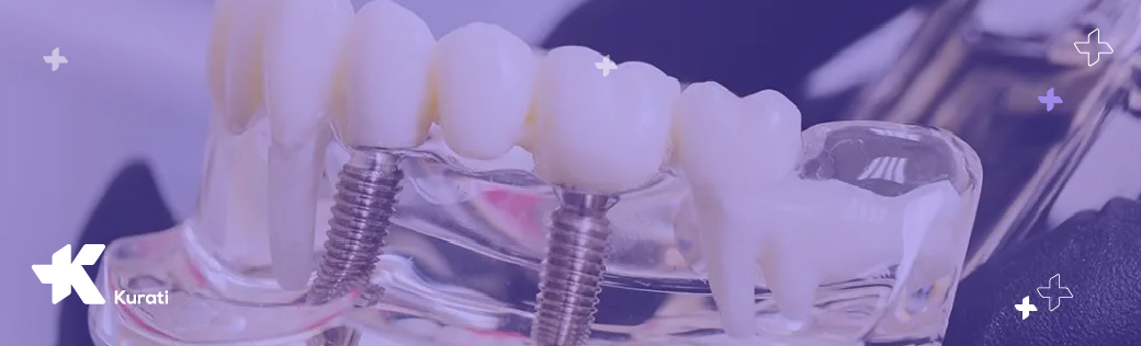 Imagen de Implantes dentales