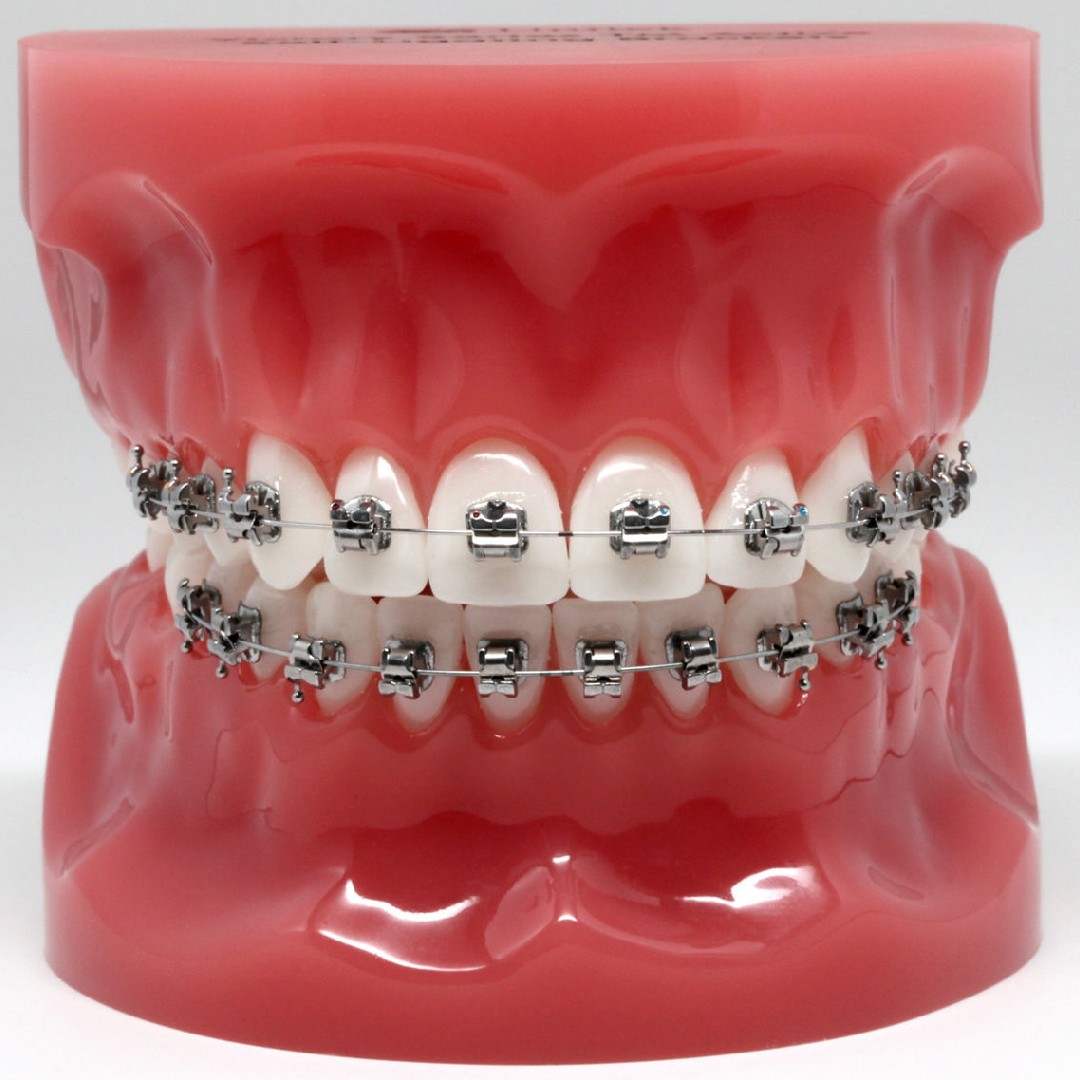 Tecnología utilizada en Qué aparatos mueven los dientes