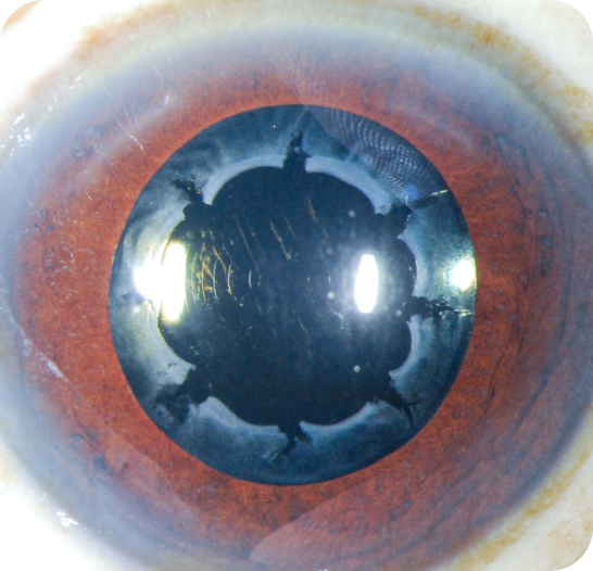 Imagen de Capsulotomía