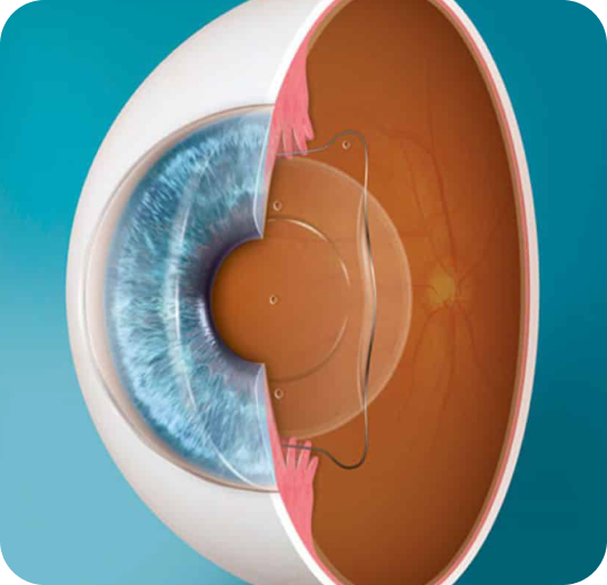 Imagen de Lentes fáquicos