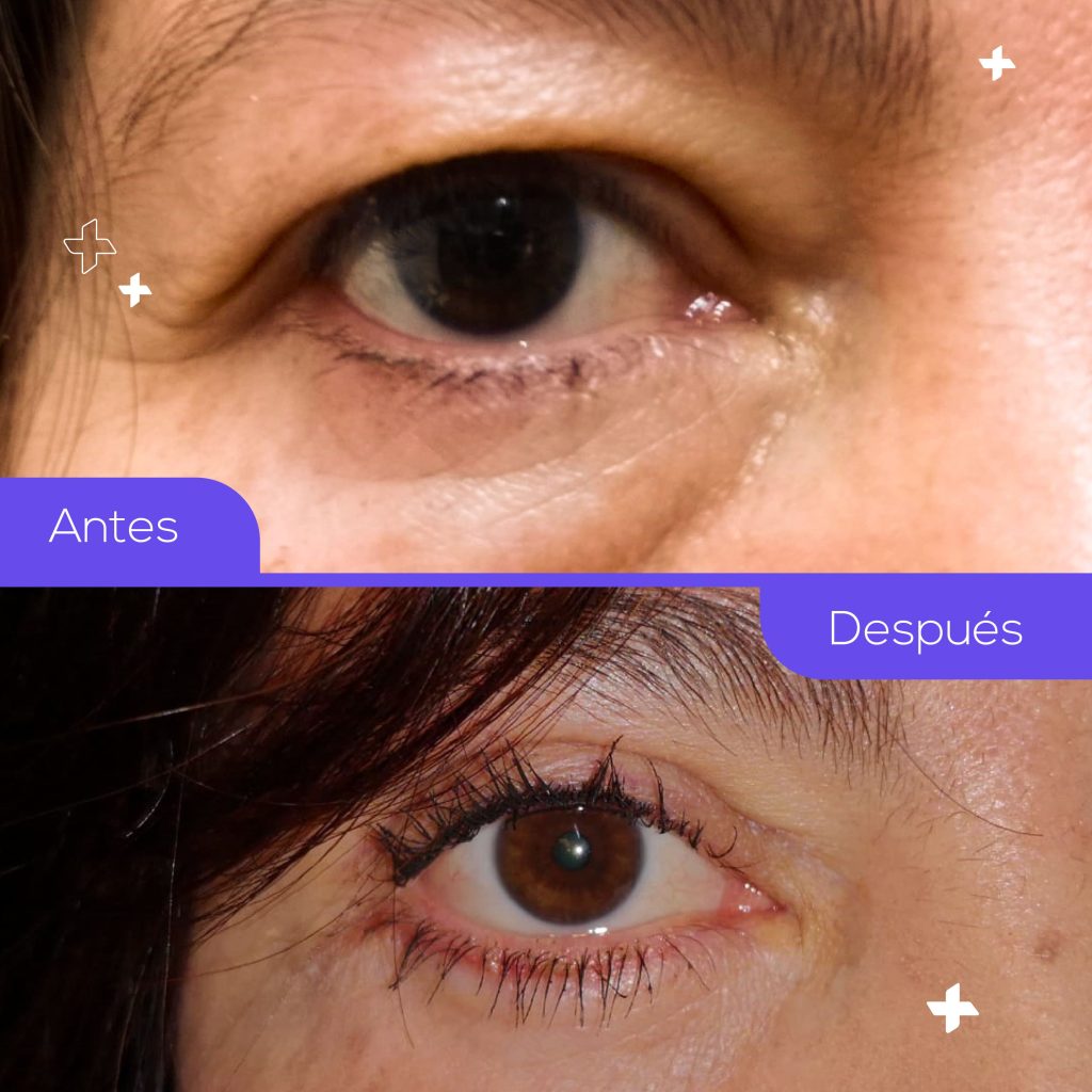 blefaroplastia antes despues imagen 01