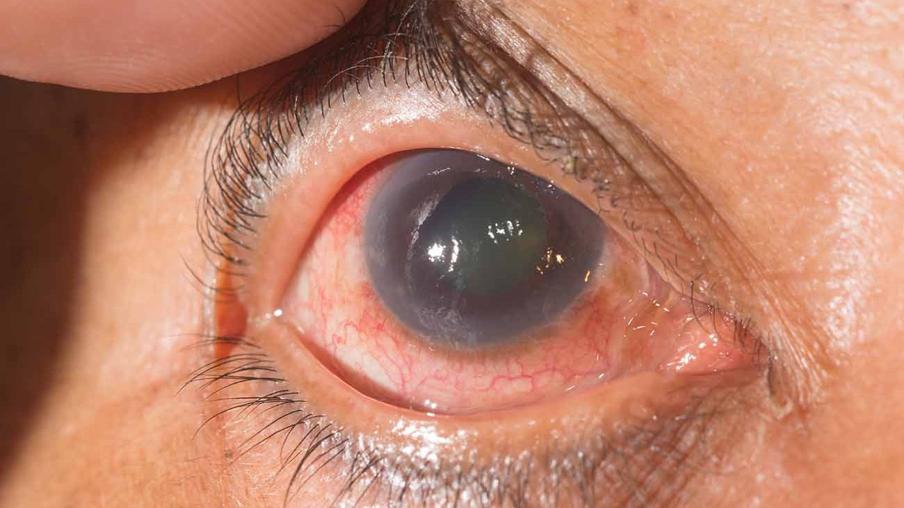 imagen glaucoma 01