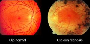 imagen retinitis pigmentaria 01