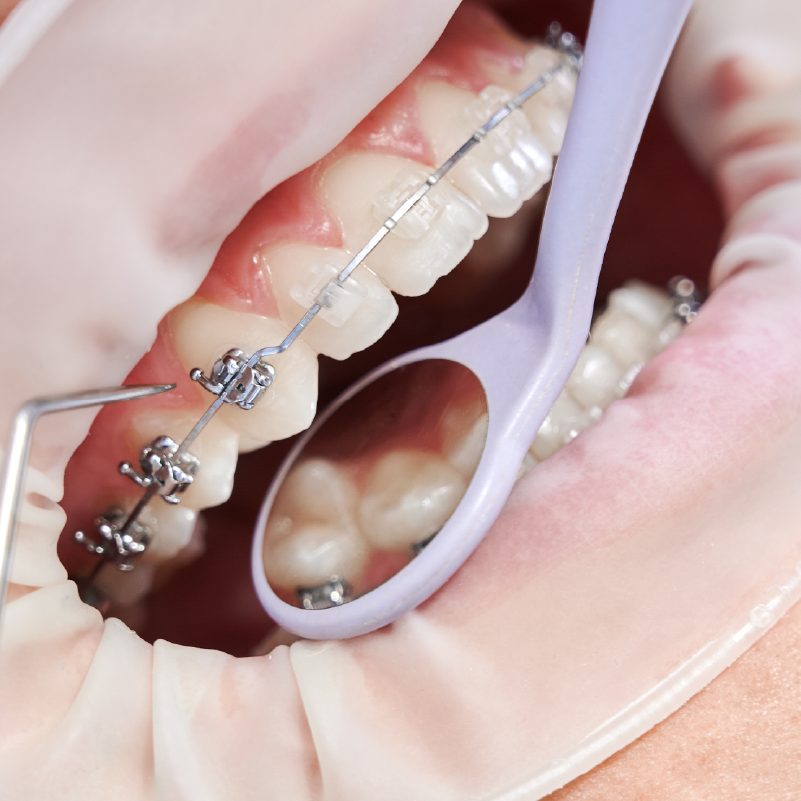procedimiento ortodoncia y endodoncia procedimiento ortodoncia y endodoncia