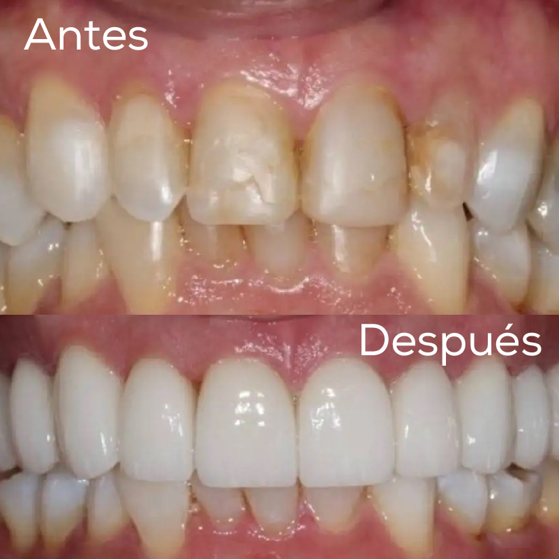 Diseño de Sonrisa - Kurati