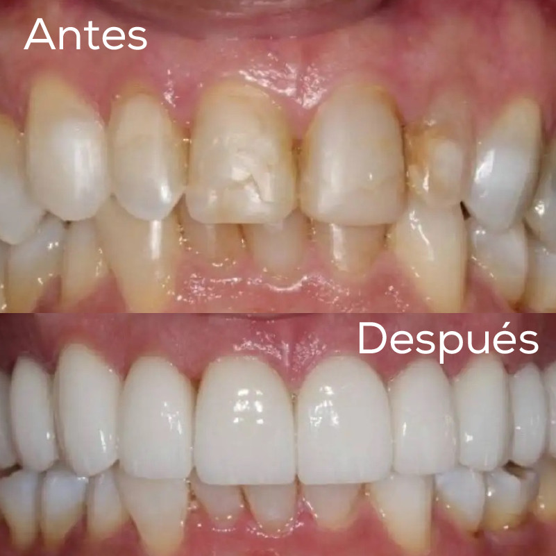antes despues diseno sonrisa