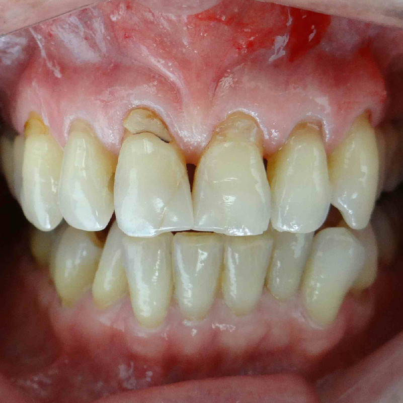 candidatos tratamiento encias