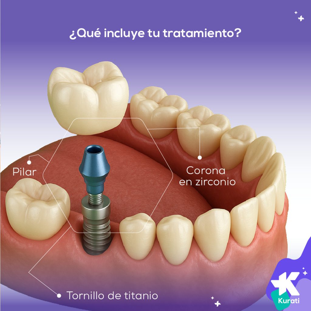 tratamiento implante dental bogota