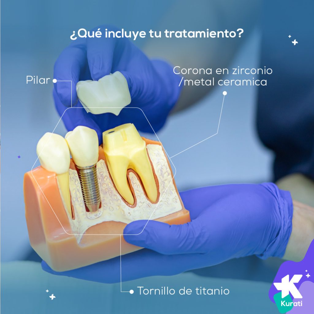 tratamiento implante dental colombia